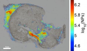 Figure. Tissue histology qPA image of human squamous cell carcinoma overlain by bright-field optical image of iron-oxide nanoparticles.